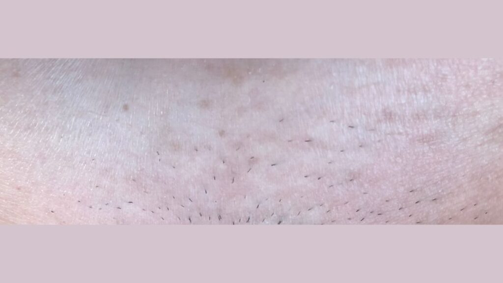 結論：脱毛器を使う時の毛の長さは「0.5mm〜1mm（黒い点が見える程度）」がベスト