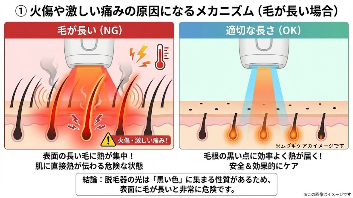 毛が生えたままの照射は絶対NG！火傷のリスクと効果が下がる理由