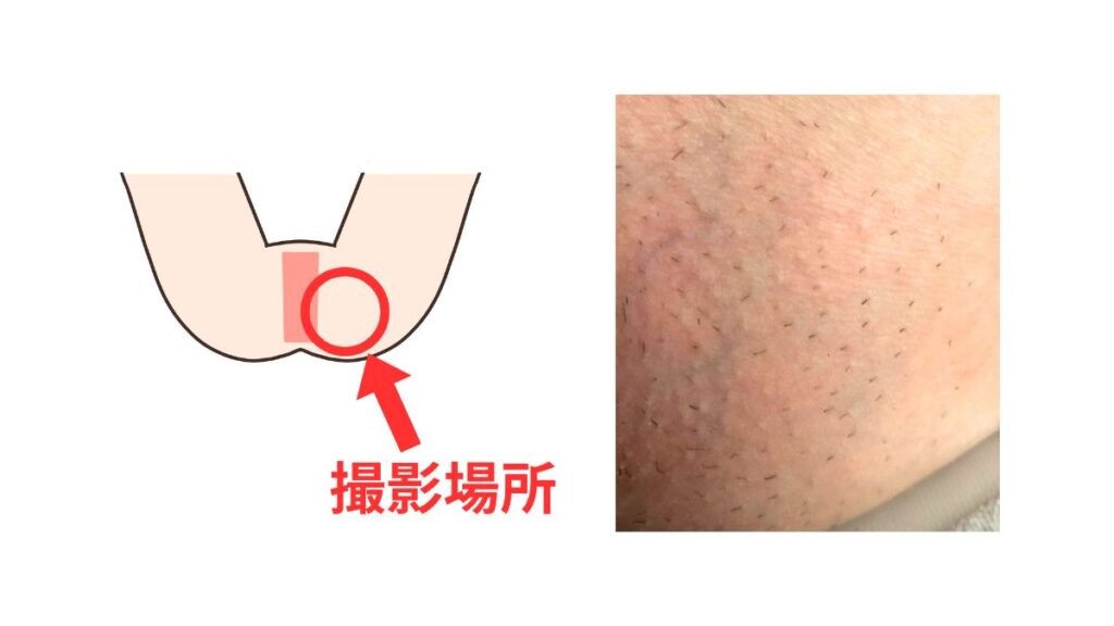 写真検証：フェリエで剃るとチクチクするのはなぜ？「ツルツルにならない」原因を拡大