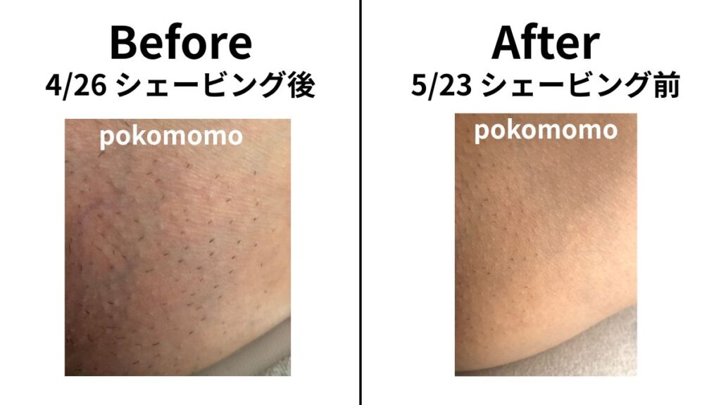 【元からケア】チクチク地獄を卒業するには「ケアして肌触りを整える」しかない